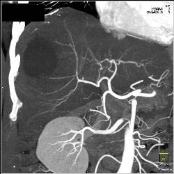 Hepatic Cyst - CTisus CT Scan