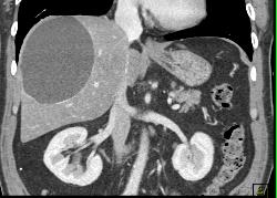 Hepatic Cyst - CTisus CT Scan