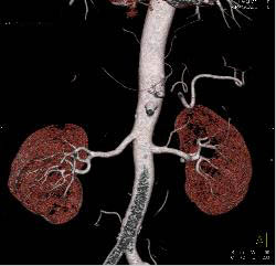 Normal Hepatic Arterial Anatomy - CTisus CT Scan