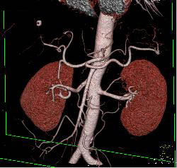 Normal Hepatic Arterial Anatomy - CTisus CT Scan