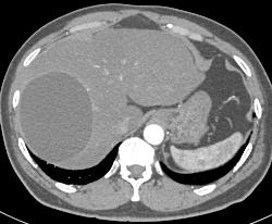 Hepatic Cyst - CTisus CT Scan