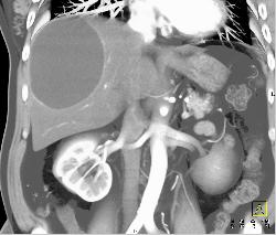 Hepatic Cyst - CTisus CT Scan