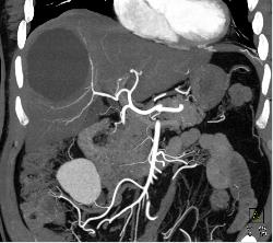 Hepatic Cyst - CTisus CT Scan