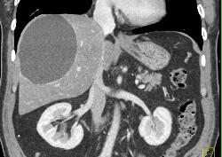 Hepatic Cyst - CTisus CT Scan