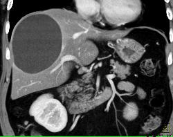 Hepatic Cyst - CTisus CT Scan