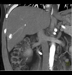 Hepatocellular Carcinoma (Hepatoma) With Neovascularity - CTisus CT Scan