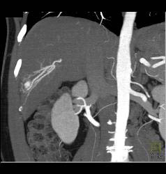 Hepatocellular Carcinoma (Hepatoma) With Neovascularity - CTisus CT Scan