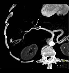 Hepatocellular Carcinoma (Hepatoma) With Neovascularity - CTisus CT Scan