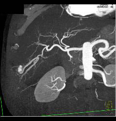 Hepatocellular Carcinoma (Hepatoma) With Neovascularity - CTisus CT Scan