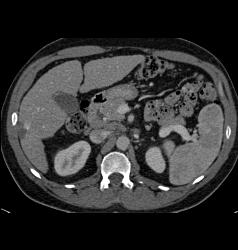 Hepatocellular Carcinoma (Hepatoma) With Neovascularity - CTisus CT Scan