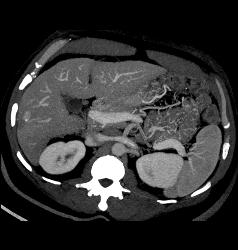 Hepatocellular Carcinoma (Hepatoma) With Neovascularity - CTisus CT Scan