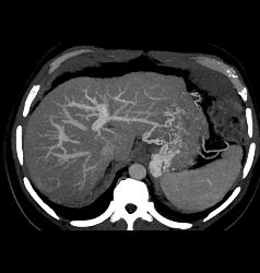 Hepatocellular Carcinoma (Hepatoma) With Neovascularity - CTisus CT Scan