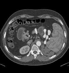 Cirrhosis With Portal Hypertension and Varices - CTisus CT Scan