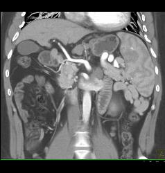 Cirrhosis With Portal Hypertension and Varices - CTisus CT Scan