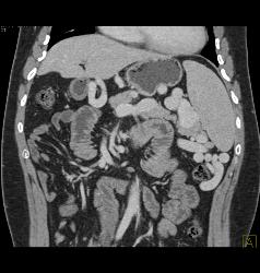 Cirrhosis With Portal Hypertension and Varices - CTisus CT Scan