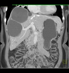 Multiple Hepatic Cysts - CTisus CT Scan