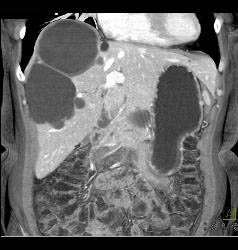 Multiple Hepatic Cysts - CTisus CT Scan