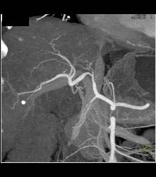 Subtle Vascular Metastases - CTisus CT Scan