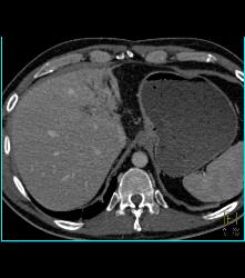 Subtle Vascular Metastases - CTisus CT Scan