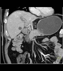 Subtle Vascular Metastases - CTisus CT Scan