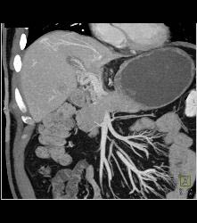 Subtle Vascular Metastases - CTisus CT Scan