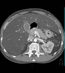 Fatty Liver - CTisus CT Scan