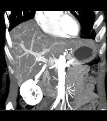 Vascular Metastases Due to Carcinoid Tumor - CTisus CT Scan