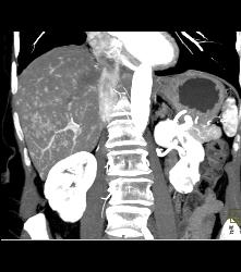 Vascular Metastases Due to Carcinoid Tumor - CTisus CT Scan