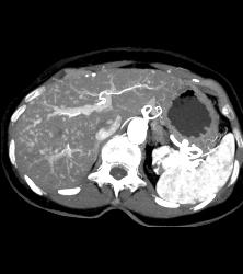 Cirrhosis With Huge Varices and Dilated Gonadal Vein - CTisus CT Scan