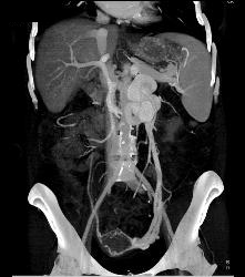 Cirrhosis With Huge Varices and Dilated Gonadal Vein - CTisus CT Scan