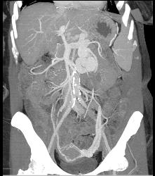 Cirrhosis With Huge Varices and Dilated Gonadal Vein - CTisus CT Scan