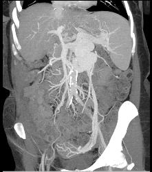 Cirrhosis With Huge Varices and Dilated Gonadal Vein - CTisus CT Scan