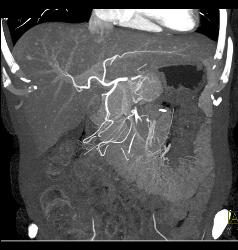 Liver Metastases Due to Neuroendocrine Primary - CTisus CT Scan