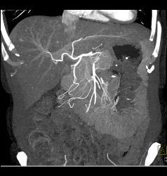 Liver Metastases Due to Neuroendocrine Primary - CTisus CT Scan