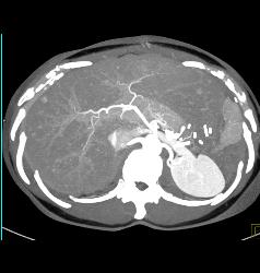 Liver Metastases Due to Neuroendocrine Primary - CTisus CT Scan