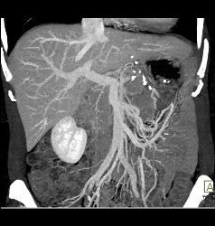 Liver Metastases Due to Neuroendocrine Primary - CTisus CT Scan