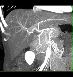 Liver Metastases Due to Neuroendocrine Primary - CTisus CT Scan