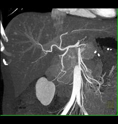 Liver Metastases Due to Neuroendocrine Primary - CTisus CT Scan