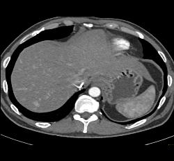 Liver Metastases Due to Neuroendocrine Primary - CTisus CT Scan