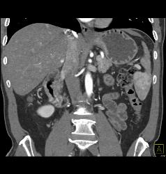 Liver Metastases Due to Neuroendocrine Primary - CTisus CT Scan