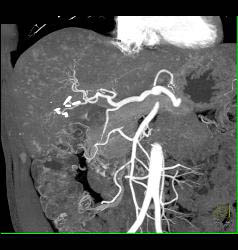 Liver Metastases Due to Neuroendocrine Primary - CTisus CT Scan