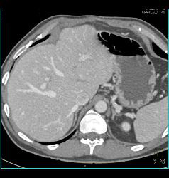 Liver Metastases Due to Neuroendocrine Primary - CTisus CT Scan