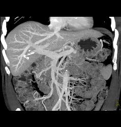 Liver Metastases Due to Neuroendocrine Primary - CTisus CT Scan