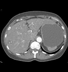 Subtle Vascular Lesions Only Seen on Arterial Phase - CTisus CT Scan