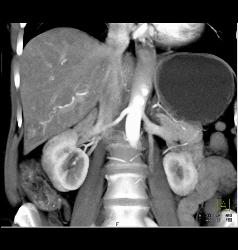 Subtle Vascular Lesions Only Seen on Arterial Phase - CTisus CT Scan