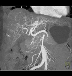 Subtle Vascular Lesions Only Seen on Arterial Phase - CTisus CT Scan