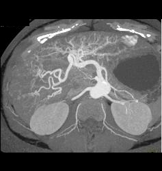 Subtle Vascular Lesions Only Seen on Arterial Phase - CTisus CT Scan