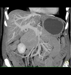 Subtle Vascular Lesions Only Seen on Arterial Phase - CTisus CT Scan