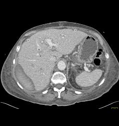 Subcapsular Bleed - CTisus CT Scan