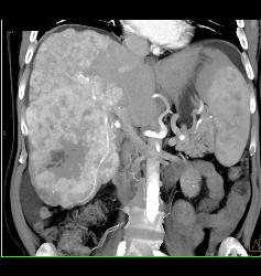 Hepatocellular Carcinoma (Hepatoma) - CTisus CT Scan